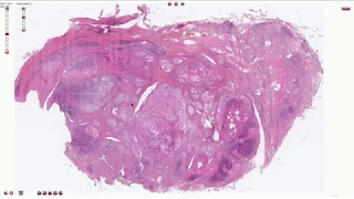 Hashimoto Thyroiditis - Histopathology