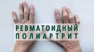 Что такое ревматоидный полиартрит?