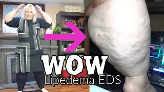 Vibration Plate as a Fat Person Lipedema and EDS Vibration Allergy