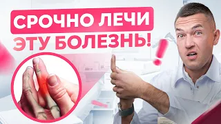 Щелкающий палец НУЖНО лечить! Что делать если пальцы не разгибаются? Болезнь Нотта