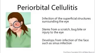 Periorbital cellulitis