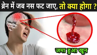 सिर की नस फटने से क्या होता है ? | Brain Haemorrhage Symptoms | Brain Hemorrhage Reason In Hindi