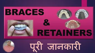 BRACES & RETAINERS, कौन सा Retainer सबसे अच्छा है, किस समय लगाना है, कितने समय लगाना है,खर्चा