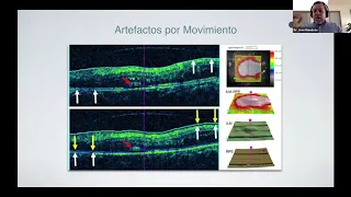 Conferencia: OCT y OCT Angiografia