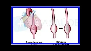 Behandlung von Aortenaneurysma