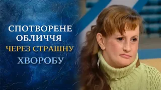 Мою дочь изуродовала болезнь! (полный выпуск) | Говорить Україна