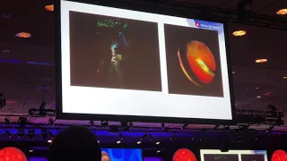 Indications and Surgical Techniques for Choroidal Tumor Biopsy Zelia M Correa MD