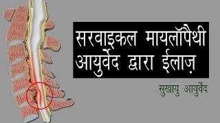 सर्वाइकल मयेलोपथी (Cervical Myelopathy): बिना सर्जरी आयुर्वेद द्वारा सुखायु आयुर्वेद पर इलाज़ संभव है