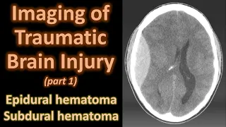 Imaging of Traumatic Brain Injury : Epidural and subdural hematoma