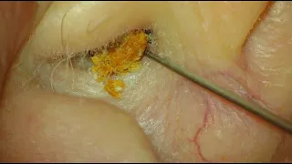 SKIN PEELS 3 CASES : EAR WAX REMOVAL : COMPILATION #5 : 4K/HD
