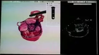 How to image the pulmonary veins by TEE?