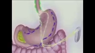 Bariatric Surgery - vBloc Animation Video