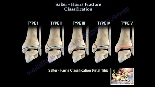 Salter Harris Fracture Classification - Everything You Need To Know - Dr. Nabil Ebraheim