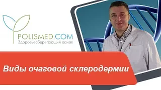 Виды очаговой склеродермии: бляшечная, линейная, пятнистая, кольцевидная. Склередерма Бушке