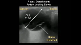 How To: Ocular Ultrasound Part 2 Case Study Video