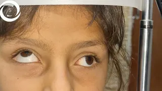 The Ophthalmic Signs (Strabismus)