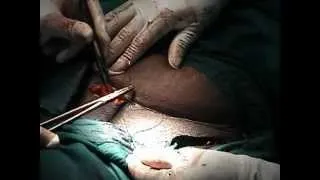 Caesarean Section: Closure of the abdomen