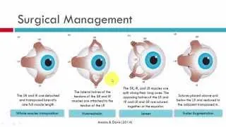 VIth CN Palsy Management