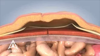 Ventral Hernia Repair - 3D Medical Animation