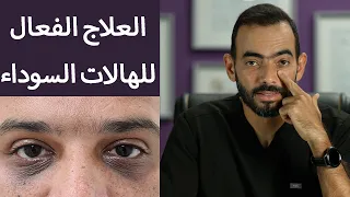 أنواع الهالات السوداء والعلاجات الفعالة