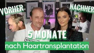 Haartransplantation VORHER NACHHER Türkei 5 Monate - Was ist passiert, wie sieht es jetzt aus?