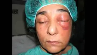 orbital cellulitis