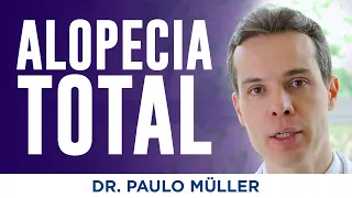 Alopecia Areata Total – Queda de todos os cabelos – Dr. Paulo Müller Dermatologista