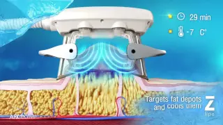 Fat Reduction - ZLipo by Zimmer (3D Medical Animation - Ultrasound Freezing Fat Cells)