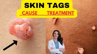 SKIN TAGS CAUSE AND NATURAL TREATMENTS. Link Between Diabetes, Insulin Resistance and Skin Tags.