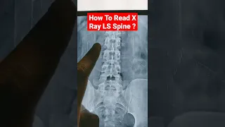 How To Read X Ray LS Spine ? Dr Sai Chandra