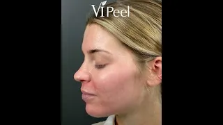 VI Peel Process | What To Expect When You're Peeling!