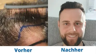 8 Monate nach meiner Haartransplantation | Vorher Nachher