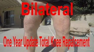Bilateral Total Knee Replacement One Year Update BTKR Pain Mikey Mike's journey Stairs Pool Peloton