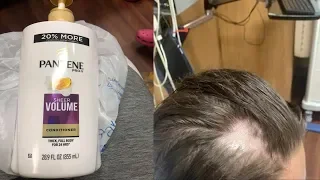 Girl Goes Bald After Someone Puts Nair In Shampoo At Walmart