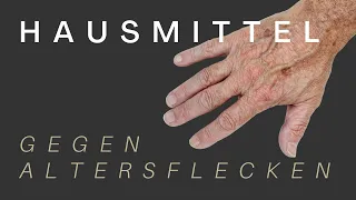 Hausmittel gegen PIGMENTFLECKEN & ALTERSFLECKEN » wie du sie innerhalb KÜRZESTER Zeit los wirst!