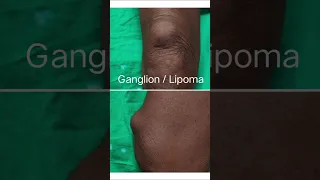 Ganglion cyst excision|Lipoma excision|Thigh local swelling removal|Lipoma removal surgery-Dr Vinoth