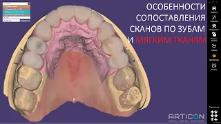 ОСОБЕННОСТИ СОВМЕЩЕНИЯ СКАНОВ В EXOCAD. Правильная тактика подгрузки waxup-скана и prep-скана