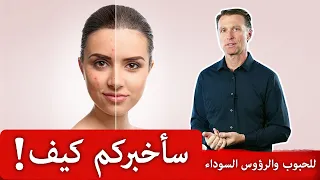 أوقفوا منتجات الوجه واتبعوا هذه الوصفة لبشرة صافية خالية من الحبوب