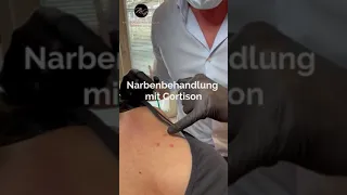 Narbenbehandlung mit Cortison by DoctorGroos😍