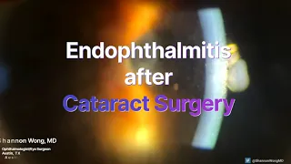 Endophthalmitis after cataract surgery.