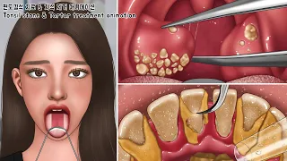 ASMR Extreme Tonsil Stone Treatment & Giant Tartar Removal Animation | White Tongue