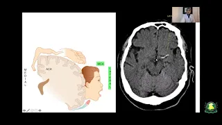 Neurology Case Student Session  CVA By Dr Asima Cheema