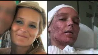 Acid Attack Victim On Her Amazing Recovery Thanks To The Lumenis UltraPulse