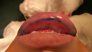 Биополимерный гель в губы - какие последствия