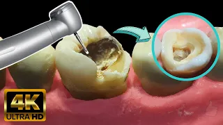 Endodontics in tooth with deep caries - Root canal treatment