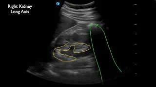 Ureterolithiasis at the Ureterovesical Junction (UVJ) with Twinkle Artifact