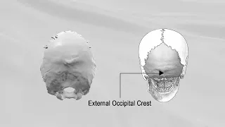 OCCIPITAL BONE