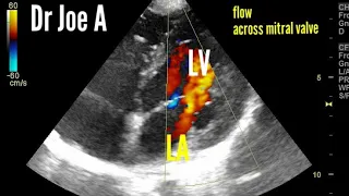 Normal adult echocardiography, ultrasound and color Doppler video, normal heart