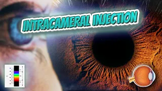 Intracameral injection (Your EYEBALLS) 👁️👁️💉😳💊🔊💯✅