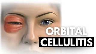 Orbital Cellulitis: A Comprehensive Guide to Diagnosis and Management